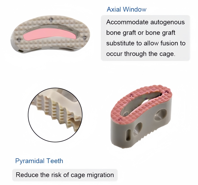 TLIF Peek Cage