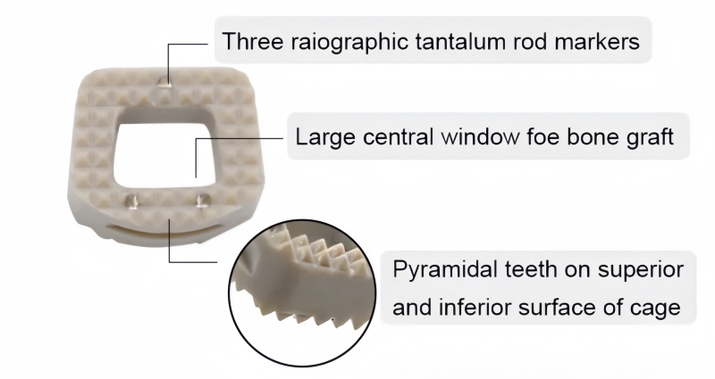 Cervical Peek Cage 