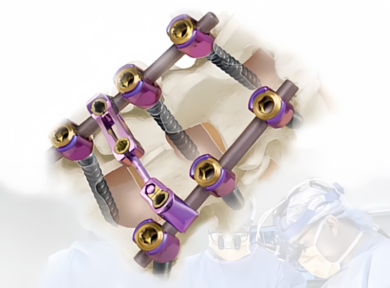 6.0 Spinal Pedicle Screw System