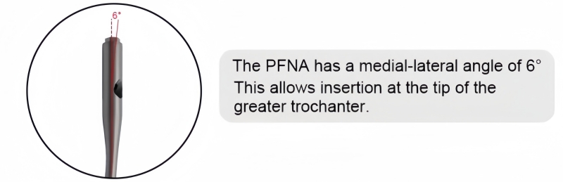 PFNA Nail