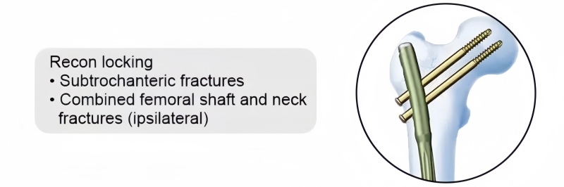 Expert Femoral Nail