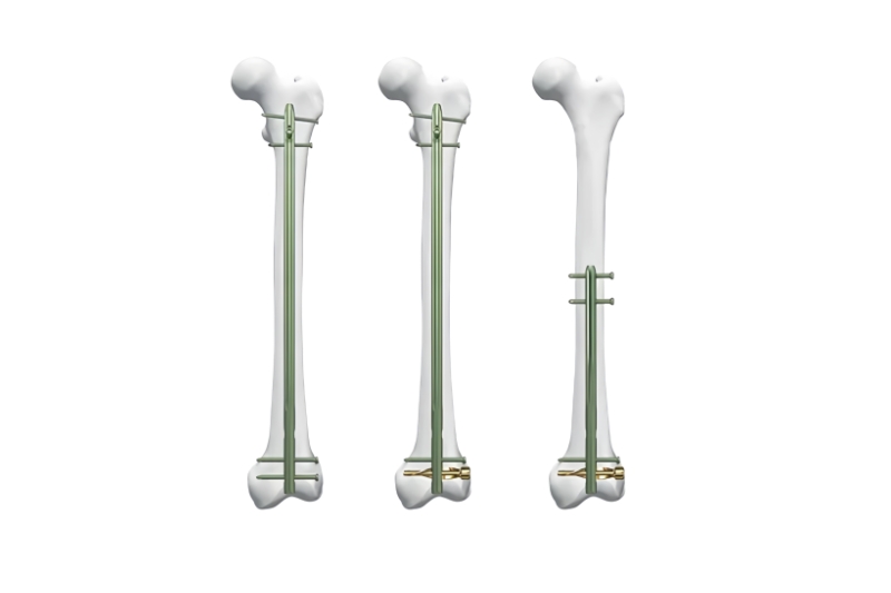 DFN Distal Femur Intramedullary Nail